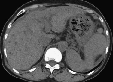 FIG 44-11, Multiple nodular fatty deposition in type C cirrhotic liver. On precontrast CT, multiple small hypodense nodules are observed in the liver. Multiple nodular fatty depositions were confirmed by MRI and follow-up studies.