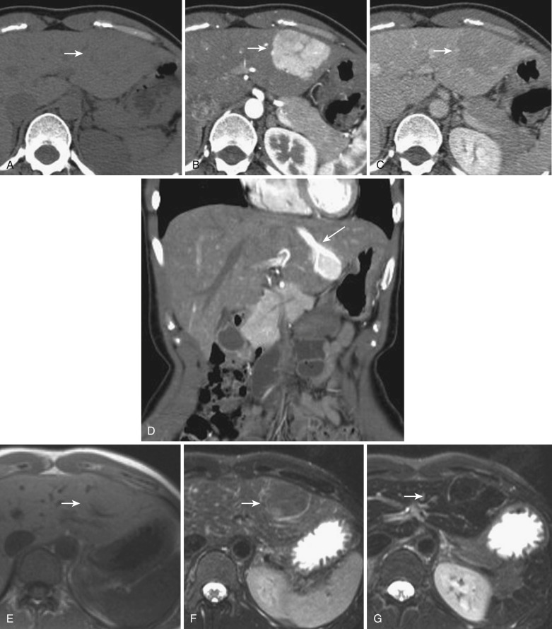 FIG 44-12, Focal nodular hyperplasia in a 44-year-old woman. A to C, On precontrast CT scan there is a homogeneous slightly hypodense mass with a central scar (slightly more hypodense) in the lateral segment of the liver ( arrow in A ). B, The lesion shows homogeneous enhancement with a less-enhanced central scar in the arterial phase (arrow) . C, It is relatively hypodense compared with surrounding liver parenchyma, with a slightly enhanced central scar in the equilibrium phase (arrow) . D, Direct draining from the tumor to the left hepatic vein (arrow) is observed on a coronal reconstruction of arterial-phase CT. The tumor shows isointensity (arrow) on T1- ( E ) and T2-weighted ( F ) MRIs. It demonstrates isointensity to the surrounding background liver parenchyma (arrow) on a SPIO-enhanced T2-weighted MRI ( G ), which represents the tumor's uptake of SPIO.