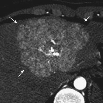 FIG 44-13, Focal nodular hyperplasia in a 15-year-old girl. The arterial phase of dynamic CT shows an enhanced tumor (arrows) and the feeding arteries radiating from the central scar to the periphery (spoke-wheel pattern).