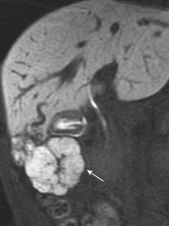 FIG 44-14, Retention of hepatobiliary contrast agent in a 34-year-old man with focal nodular hyperplasia. In the delayed-phase (hepatobiliary-phase) T1-weighted image obtained 20 minutes after administration of Gd-EOB-DTPA, the tumor shows prolonged enhancement (arrow) that represents uptake of the contrast agent by hepatocytes.