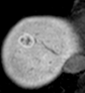 FIG 44-15, Donut or ringlike peripheral retention of hepatobiliary contrast agent in focal nodular hyperplasia. In the delayed-phase (hepatobiliary-phase) T1-weighted image obtained 20 minutes after administration of Gd-EOB-DTPA, the central scar portion shows lower expression of organic anion transporter polypeptide, and the tumor shows donut or ringlike peripheral retention of contrast agent.