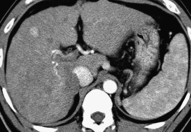 FIG 44-16, Hypervascular macroregenerative nodule in Budd-Chiari syndrome in a 28-year-old man. The nodule shows hyperdensity in the arterial phase of dynamic CT. The nodule demonstrated hyperintensity on T1- and isointensity on T2-weighted MRIs (not shown).