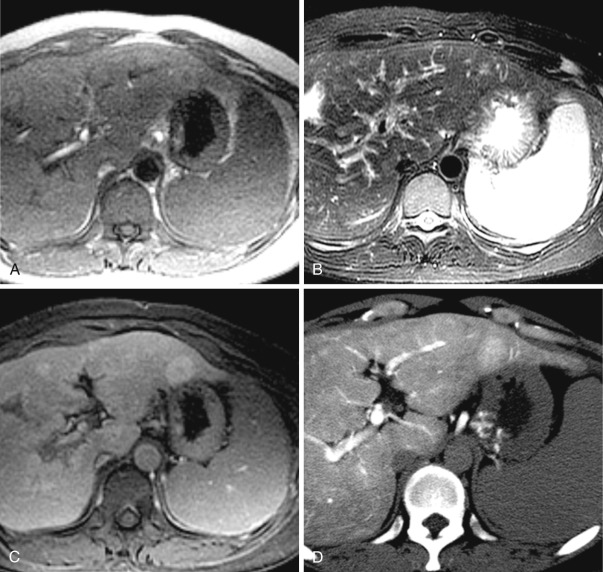 FIG 44-17, Nodular regenerative hyperplasia in idiopathic portal hypertension. A, On T1-weighted MRI, there is a hyperintense nodule with a central hypointense portion. B, On T2-weighted MRI, the nodule appears hypointense with a central hyperintense portion. C, On hepatobiliary-phase Gd-ROB-DTPA–enhanced MRI, the nodule shows hyperintensity that reflects uptake of EOB. D, On CTAP, the nodule appears hyperdense compared to the background liver, which suggests increase of portal flow compared to the surrounding liver.