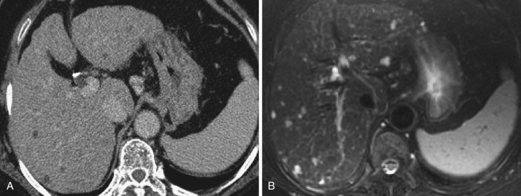 FIG 44-18, Multiple biliary hamartomatosis (von Meyenburg's complex). A, On postcontrast CT, there are multiple minute hypodense nodules throughout the liver. B, On T2-weighted MRI at the same level, the nodules exhibit extreme hyperintensity. Most of the nodules are difficult to recognize on CT because of the partial volume effect.