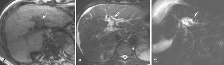 FIG 44-19, Peribiliary cysts. A, Tubular hypointense lesions are apparent along the large portal vein, especially in the hepatic hilum area (arrow) , on T1-weighted MRI. B, On T2-weighted MRI these lesions show hyperintensity (arrow). Actually, these lesions are not tubular but represent multiple small cysts around the large bile duct. C, On MRCP, multiple hyperintense cystic lesions are observed around large bile ducts in the hepatic hilum area (arrow) .