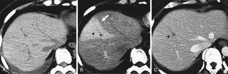 FIG 44-2, Segmental staining caused by intrahepatic portal vein thrombosis. Although there are no attenuation differences in the liver on precontrast ( A ) and equilibrium-phase ( C ) CT scan, a wedge-shaped enhanced area is observed in segment VIII of the liver in the arterial phase ( B ) (arrow). A linear hypodense lesion that indicates a thrombus is observed in the portal vein (arrowhead).