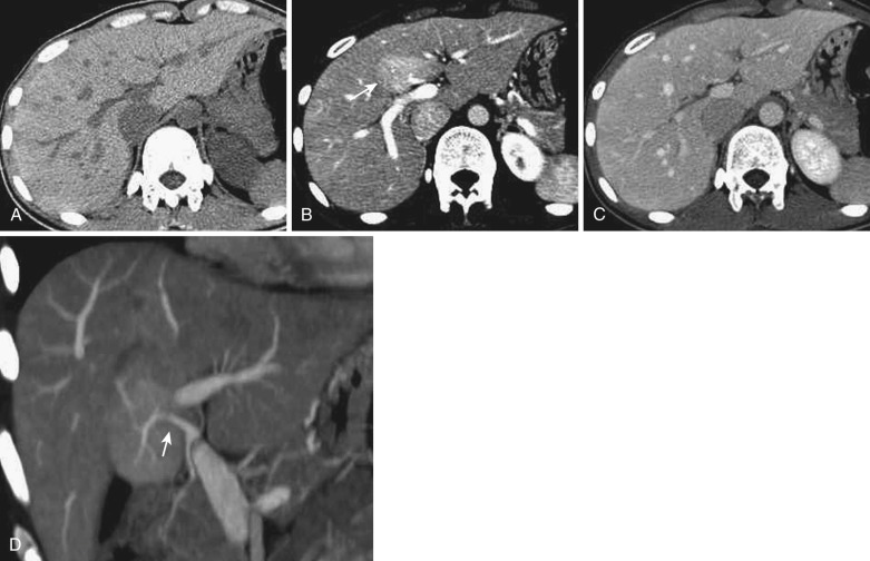 FIG 44-3, Hypervascular pseudolesion in the posterior aspect of segment IV caused by an aberrant right gastric vein. A to C, Liver parenchyma of the posterior aspect of segment IV shows hyperdensity with a draining vein into this area on the portal phase of dynamic CT scan ( arrow in B ). This area is isodense on precontrast ( A ) and equilibrium-phase ( C ) images. D, Coronal maximum intensity projection during the portal phase indicates that the right gastric vein flows directly into this area and opacifies the parenchyma (arrow).