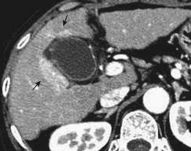 FIG 44-4, Hypervascular pseudolesion in the gallbladder fossa due to cholecystic venous drainage. Liver parenchyma around the gallbladder shows hyperdensity in the arterial phase of dynamic CT scan, owing to cystic venous drainage (arrows).
