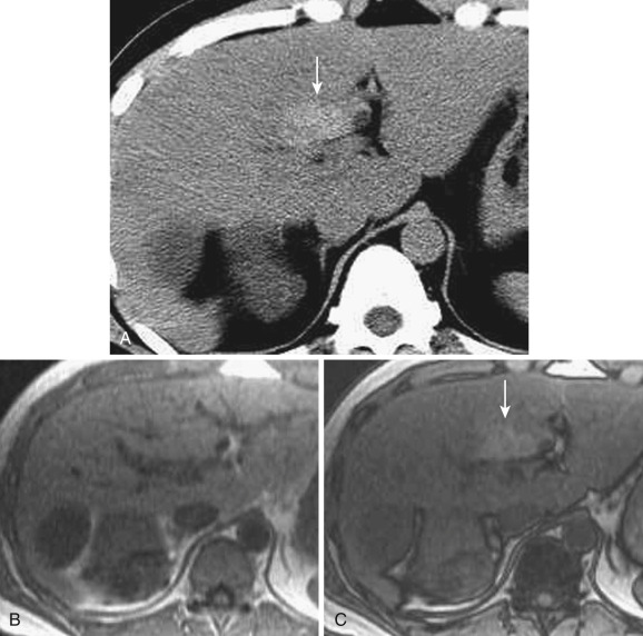 FIG 44-5, Focal sparing in the posterior aspect of segment IV caused by aberrant right gastric venous drainage. A, On precontrast CT the liver parenchyma in the posterior aspect of segment IV shows relative hyperdensity compared with the background fatty liver parenchyma (arrow) . On T1-weighted in-phase ( B ) and opposed-phase ( C ) MRIs, the liver parenchyma—except for the posterior aspect of segment IV ( arrow in C )—has decreased intensity in the opposed-phase image, which indicates fat deposition.