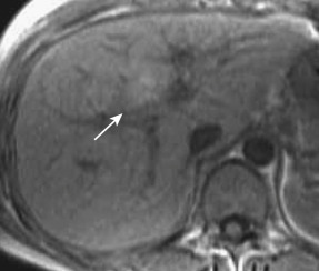 FIG 44-6, Focal fatty liver in the posterior aspect of segment IV caused by aberrant right gastric venous drainage. There is a relatively hyperattenuated round lesion (arrow) in the liver parenchyma in the posterior aspect of segment IV on in-phase T1-weighted MRI. The lesion shows hypointensity on opposed-phase T1-weighted MRI (image not shown).