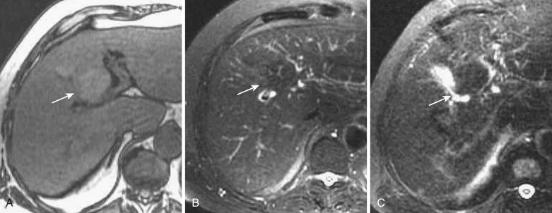 FIG 44-7, Hyperplastic change in the posterior aspect of segment IV in an alcoholic cirrhotic liver caused by aberrant right gastric venous drainage. The liver parenchyma in the posterior aspect of segment IV shows hyperintensity (arrow) on T1- ( A ) and hypointensity (arrow) on the T2-weighted image ( B ). On the SPIO-enhanced T2-weighted MRI ( C ) the area shows uptake of SPIO (arrow) and is relatively hypointense compared with the background liver parenchyma.