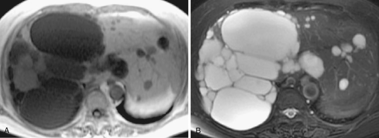 FIG 44-9, Hepatic cyst (polycystic liver). On T1-weighted ( A ) and T2-weighted ( B ) MRIs, there are multiple smooth-rimmed masses which demonstrate definite homogeneous hypointensity and hyperintensity, respectively, similar to cerebrospinal fluid. However, some of the cysts in the right lobe of the liver have a higher intensity than other cysts, which represents bleeding in the cyst (complicated cyst).