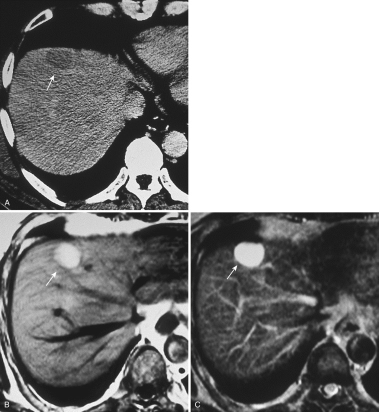 FIG 44-10, Ciliated hepatic foregut cyst. A, Postcontrast CT scan shows a nonenhanced hypodense mass beneath the anterior surface of the liver (arrow) . The internal density of the mass is higher than that of water. Both T1- ( B ) and T2-weighted ( C ) MRIs demonstrate extreme hyperintensity, reflecting a high intralesional concentration of protein (arrow) .