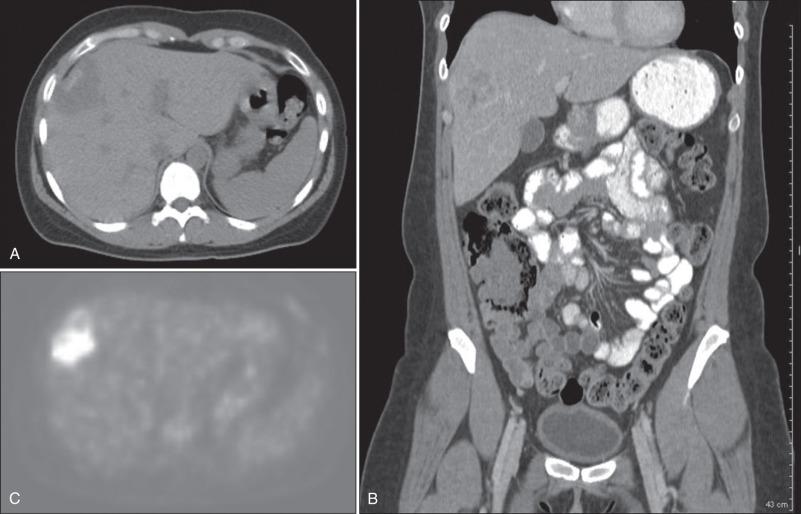 Figure 58.2, Preoperative axial (A) and coronal (B) computed tomography and corresponding positron emission tomography (C) images in a patient with hepatic metastases from colon cancer.