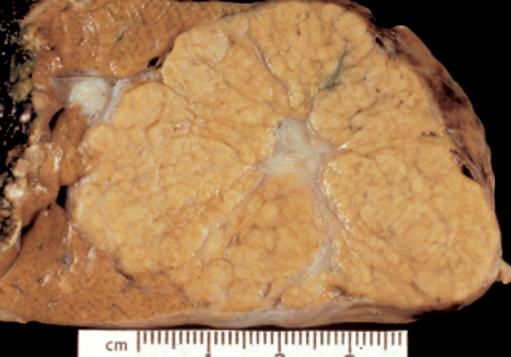 Figure 18.1, Focal nodular hyperplasia is a sharply circumscribed mass in a background of normal liver and shows a multinodular cut surface with a characteristic central scar.