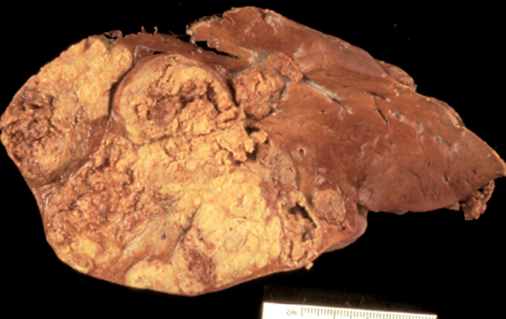 Figure 18.14, Hepatoblastoma typically presents as a single, large, soft, ﬂeshy tumor mass.