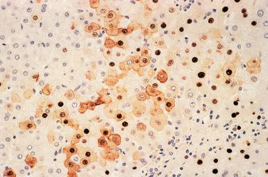 Figure 19.11, Chronic Viral Hepatitis B, Viral Replicative Phase.