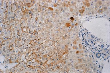 Figure 19.12, Chronic Viral Hepatitis B, Viral Replicative Phase.