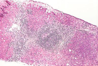 Figure 19.14, Chronic Viral Hepatitis C.