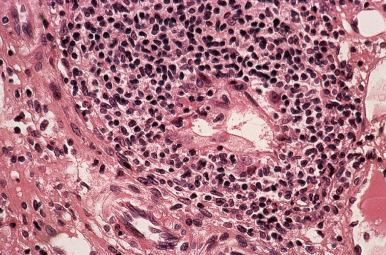 Figure 19.15, Chronic Viral Hepatitis C.