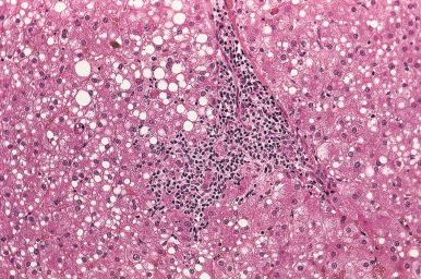 Figure 19.16, Chronic viral hepatitis C showing moderate to marked steatosis in addition to portal inflammation and mild interface hepatitis.