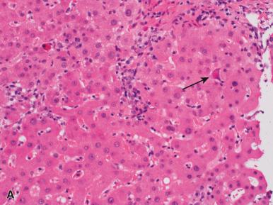 Figure 19.17, A, A poorly formed basophilic, granular CMV inclusion is present within an endothelial cell (arrow) in the sinusoids. There is surrounding patchy inflammation and scattered apoptotic hepatocytes. B, Several “owl's-eye” inclusions are seen within biliary epithelial cells (arrow) .