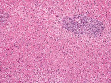 Figure 19.18, EBV hepatitis showing dense lymphocytic portal infiltrates, and a sinusoidal lymphocytosis in a “string of beads” configuration.