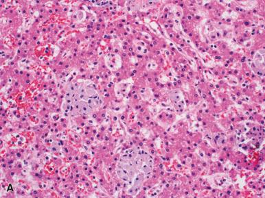 Figure 19.19, Mycobacterium Avium-Intracellulare Complex in the Liver.