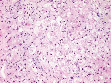 Figure 19.20, Foamy cytoplasmic vacuoles, ballooning, and numerous Mallory–Denk bodies characterize amiodarone toxicity.