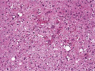 Figure 19.2, “Surgical hepatitis” features a neutrophilic infiltrate associated with necrosis of single hepatocytes or small groups of hepatocytes.