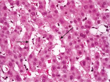 Figure 19.21, Hypervitaminosis A.