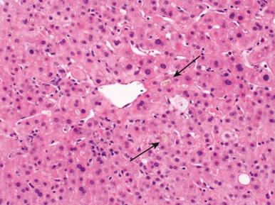 Figure 19.22, Canalicular cholestasis with bile plugs (arrows) and minimal associated inflammation in this cholestatic drug reaction secondary to antibiotics.