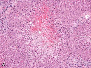 Figure 19.23, A, Centrilobular necrosis with minimal attendant inflammation in acetaminophen toxicity. Reactive binucleated hepatocytes are also present. B, Acute drug-induced liver injury featuring lobular inflammation, prominent Kupffer cells forming small clusters, and apoptotic hepatocytes (arrow) . Fibrosis is absent by definition.