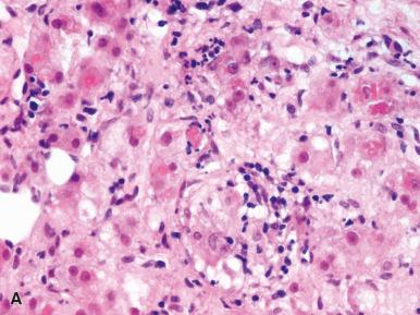 Figure 19.24, A, Fat and abundant Mallory-Denk bodies in amiodarone toxicity. B, Steatosis, reactive hepatocellular changes, and stellate cell hyperplasia secondary to HAART therapy.