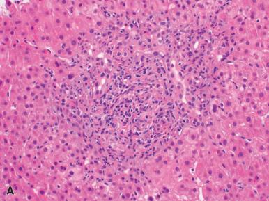 Figure 19.25, A, Lymphocytic cholangitis and interlobular bile duct damage associated with Bactrim use. B, Neutrophilic cholangitis and interlobular bile duct damage (arrow) secondary to the anti-hypertensive lisinopril. This would be difficult to distinguish from large bile duct obstruction. C, Vanishing bile duct syndrome leading to biliary cirrhosis and liver transplant secondary to antibiotic administration.