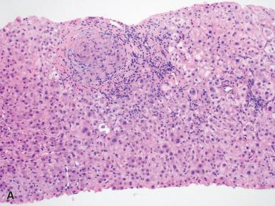 Figure 19.26, A, Noncaseating epithelioid granuloma in a portal tract, secondary to allopurinol. B, Loosely formed granuloma with numerous associated eosinophils from an adverse reaction to echinacea tea.