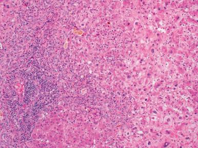 Figure 19.27, TPN-associated injury in an infant featuring ductular and canalicular cholestasis, marked ductular reaction, portal inflammation, and reactive hepatocellular changes.