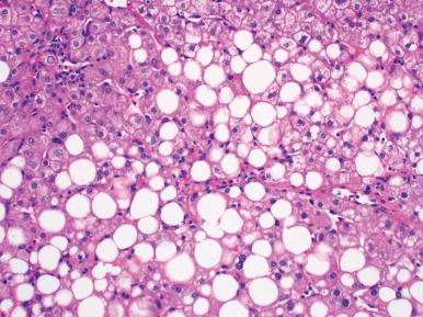 Figure 19.28, Macrovesicular steatosis featuring large droplets of fat.