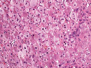 Figure 19.29, Accumulation of Tiny Lipid Droplets in Microvesicular Steatosis.