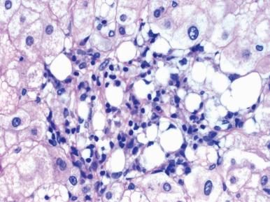 Figure 19.30, Lipogranuloma featuring adipocytes mixed with lymphocytes and macrophages.