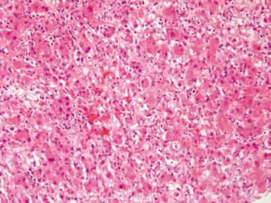 Figure 19.3, Acute hepatitis B infection characterized by ballooning of hepatocytes, lobular disarray, and mononuclear (mainly lymphocytic) inflammatory infiltration.