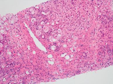 Figure 19.31, A, Alcoholic liver disease featuring marked hepatocyte ballooning, a neutrophilic infiltrate, and Mallory–Denk bodies. Steatosis is minimal in this case. B, Steatosis with well-developed ballooning and “satellitosis” of neutrophils around apoptotic hepatocytes (arrow) . C, Higher power view of Mallory–Denk bodies (arrows) .