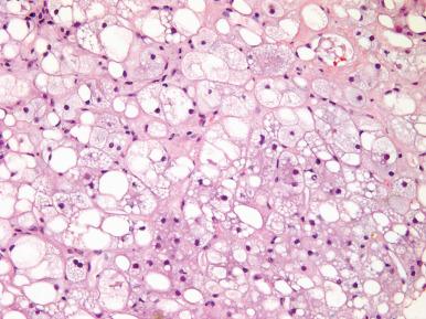 Figure 19.32, Mixed Macrovesicular and Microvesicular Steatosis.