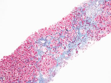 Figure 19.33, A, Pericellular or “chicken-wire” fibrosis ensheaths individual hepatocytes and small groups of hepatocytes, many of which show ballooning (Trichrome stain). B, Severe pericellular fibrosis in a case of sclerosing hyaline necrosis.