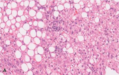 Figure 19.35, Non-alcoholic Fatty Liver Disease.