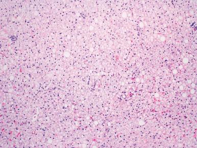 Figure 19.37, Glycogenic hepatopathy featuring enlarged, markedly pale, swollen hepatocytes due to glycogen accumulation.