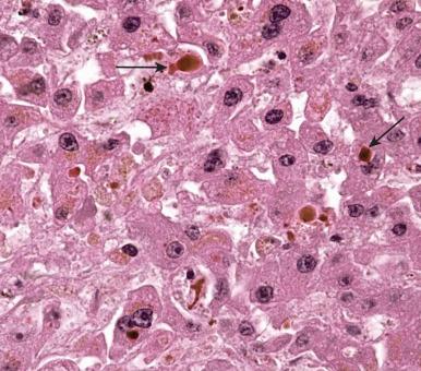 Figure 19.38, Marked bilirubinostasis in hepatocytes and bile canaliculi, leading to bile plugs in the latter (arrows) .