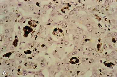 Figure 19.39, Erythropoietic Protoporphyria.