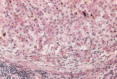 Figure 19.40, Cholate stasis in periphery of parenchymal nodule in cirrhotic liver of patient with end-stage primary sclerosing cholangitis. The hepatocytes near the fibrous septum (lower part) show hydropic swelling, clumping of the cytoplasm, and Mallory bodies.