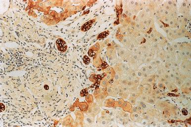 Figure 19.42, Keratin 7 immunostain highlights an increase in the number of ductular structures at the portal tract periphery; expression of keratin 7 in periportal hepatocytes is an indicator of early cholate stasis. A few scattered, small keratin 7 positive cells at some distance from the portal tract are presumed hepatic progenitor cells.